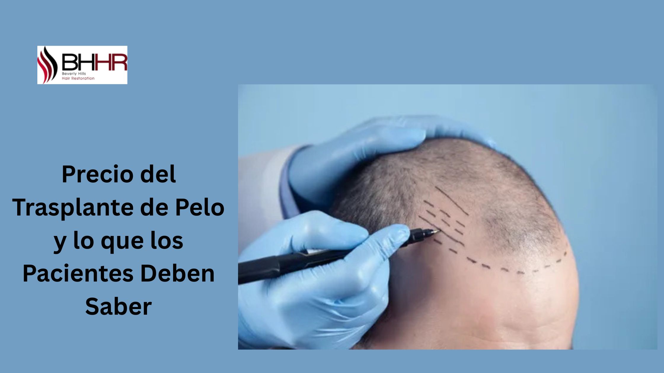 Precio del Trasplante de Pelo y lo que los Pacientes Deben Saber