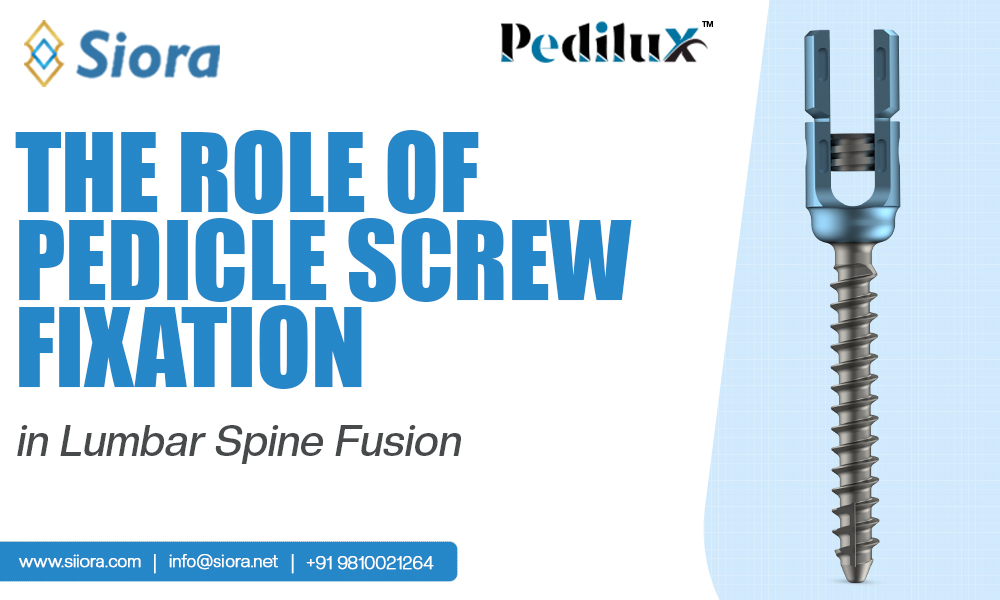 The Role of Pedicle Screw Fixation in Lumbar Spine Fusion