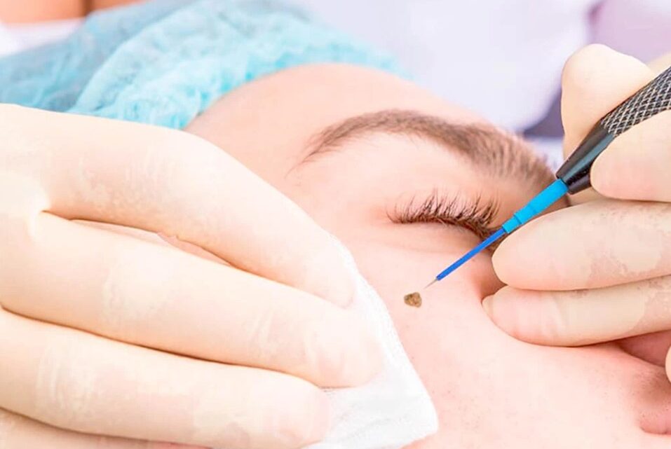 Latest Technology for Wart Removal in Islamabad – A Complete Guide