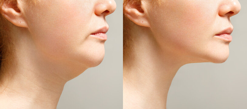 Double Chin Liposuction in Islamabad: Expert Treatment Guide