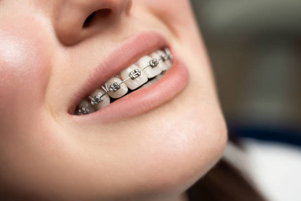 Why Early Orthodontic Treatment with Teeth Braces in Islamabad Pakistan Matters