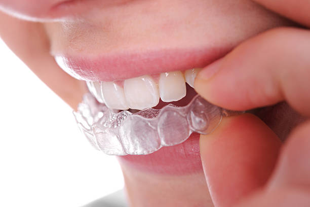 Enhancing Smiles Through Modern Orthodontic Innovation Teeth Aligners in Pakistan: