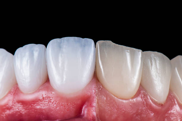 What Happens After Treatment Week by Week and Year by Year Dental Veneers in Islamabad Pakistan: