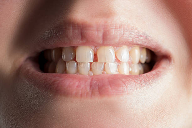 Advanced Care for Cracked, Chipped, and Broken Teeth Tooth Fracture Treatment in Pakistan: