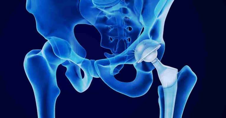 Hip Resurfacing Surgery in Dubai for Lasting Results