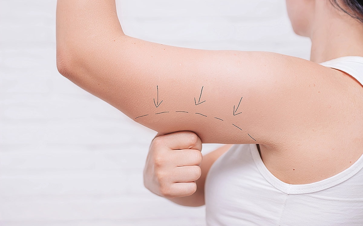 Arm Lift Surgery in Dubai: Top Clinic Choices Explained