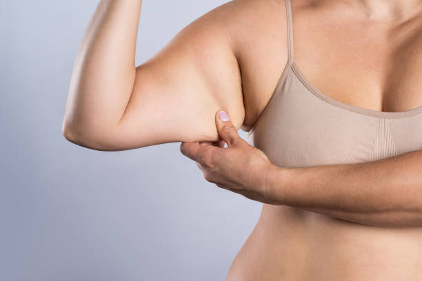 Can Fat Melting Injections Help With Arm Fat?