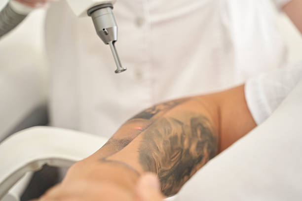 Can Laser Tattoo Removal Target Resistant Pigments?