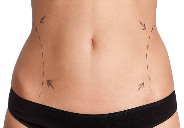 Can Lipo Abdominoplasty improve abdominal symmetry