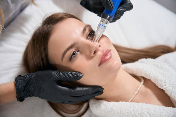 Can Microneedling Improve Fine Lines Around the Eyes?