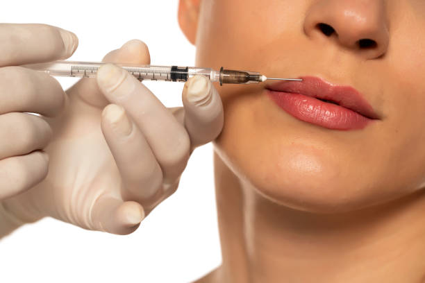 Can Russian Lip Fillers fix an uneven upper lip