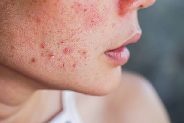 Does Acne Treatment Help With Frequent Breakouts?