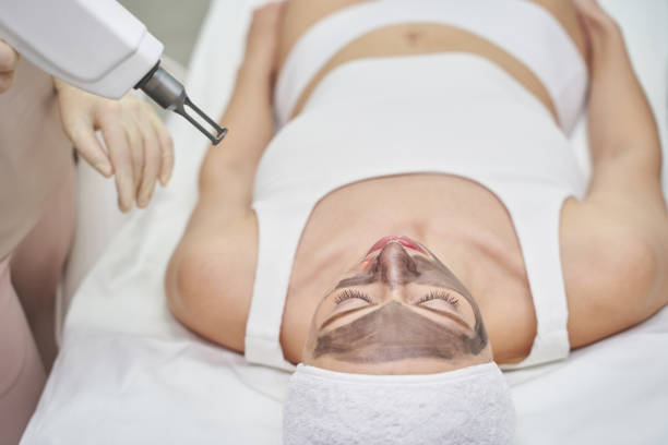 Does Laser Carbon Peel require any recovery downtime