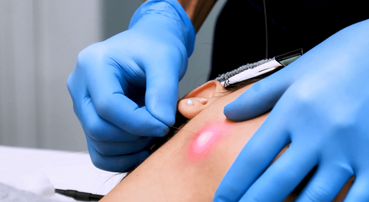 Endolift