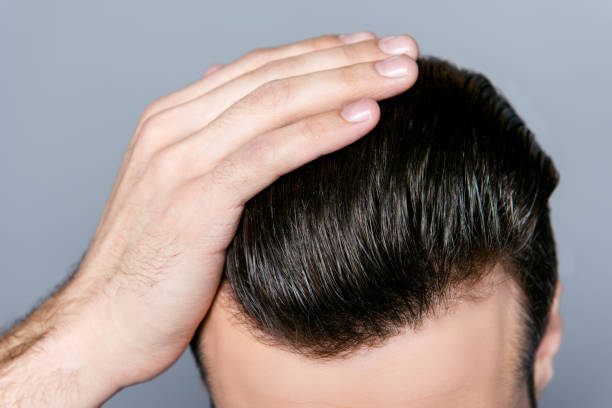 How Does Hair Transplant Create Natural Hairlines?
