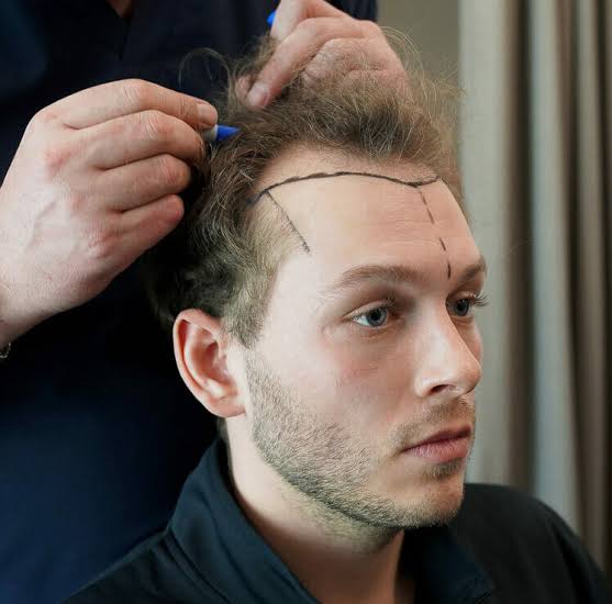 How does FUE hair transplant restore a youthful hairline?