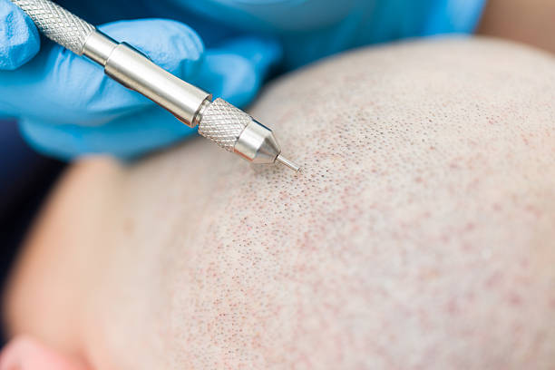How does Hair transplant fit into modern hair care?