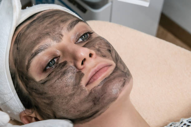 How does Laser carbon peel help control excess facial oil