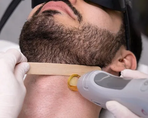 Is Beard Laser Hair Removal Right for You?