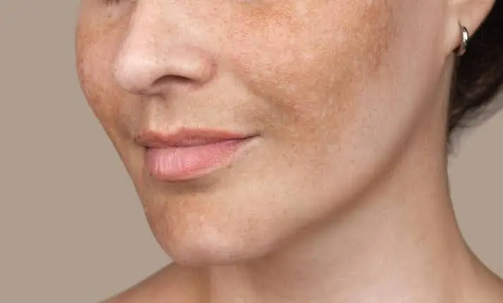 Is Pigmentation Treatment Safe for Your Skin