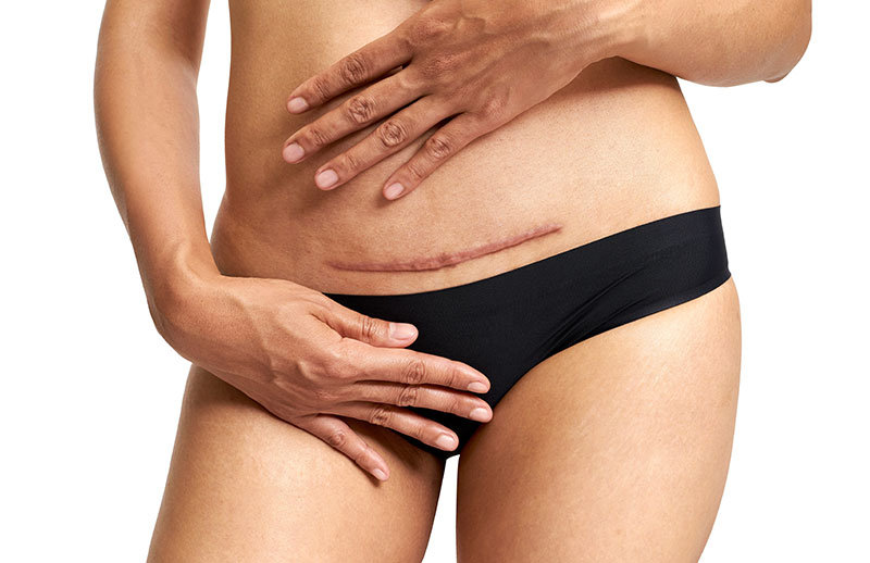 Surgical Scar Revision in Dubai Clinics Providing Precision Care