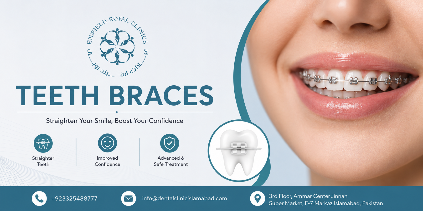 Teeth Braces in Islamabad for Beautiful Teeth