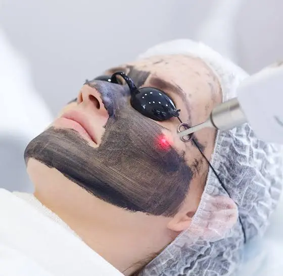 What Makes Laser Carbon Peel So Popular?