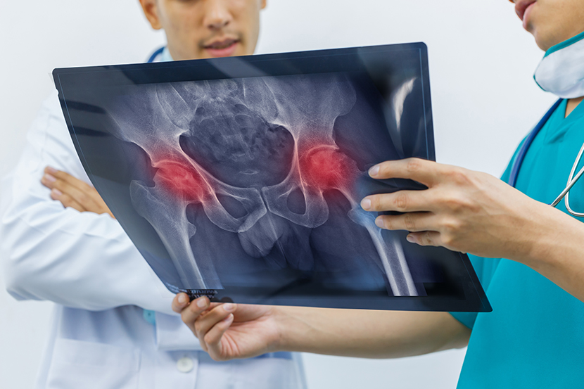 Hip Resurfacing Surgery