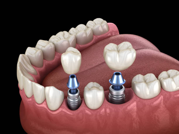 low cost dental implants