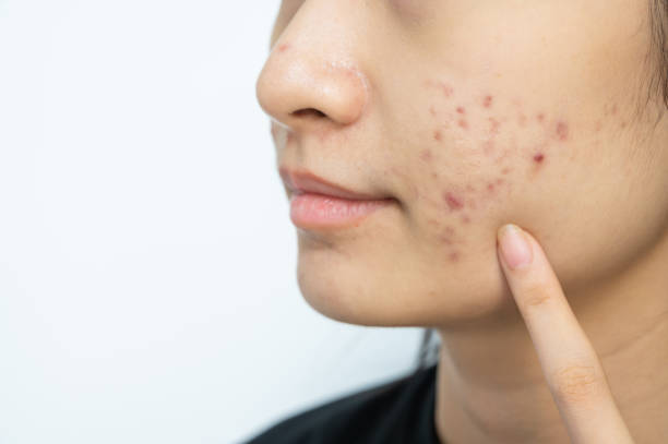 Can Acne Treatment Address Blackheads and Whiteheads