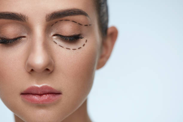 Can Blepharoplasty reduce puffiness around the eyes