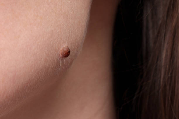 Can Children Safely Have Warts Removal Treatment