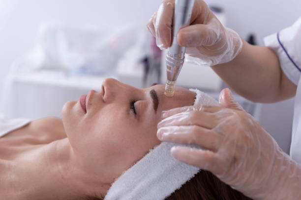 Can Fractional RF Micro Needling Treat Enlarged Pores
