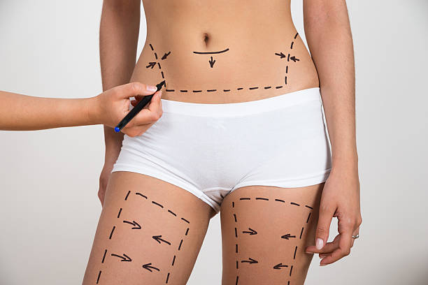 Can Lipo Abdominoplasty improve a sagging abdomen