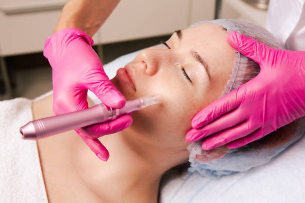 Can Microneedling Treat Different Types of Scars