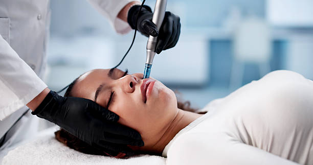 Can Microneedling soften stretch marks naturally