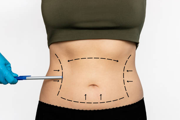 Can Tummy Tuck Surgery reduce a lower belly pouch