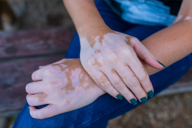 Can Vitiligo Treatment Help With Uneven Skin Color