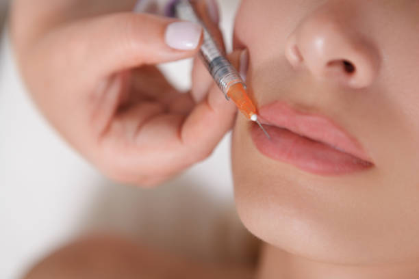Do Russian Lip Fillers give natural-looking results