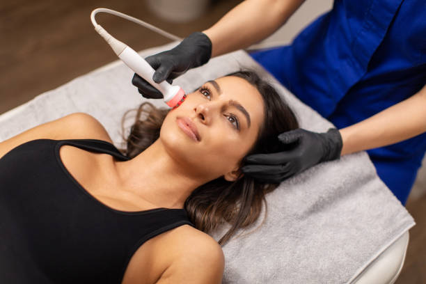 Does CO2 Laser help reduce fine lines near the eyes
