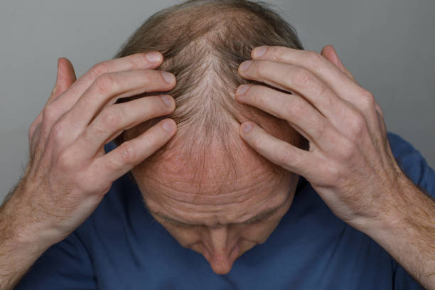 Does GFC Treatment for Hair complement hair transplant