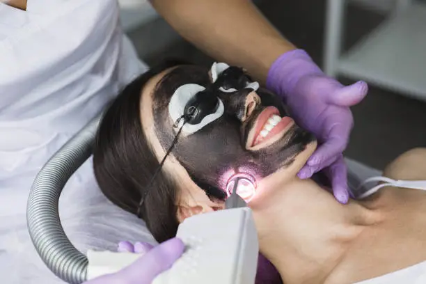 Does Laser Carbon Peel Help Reduce Visible Pores?