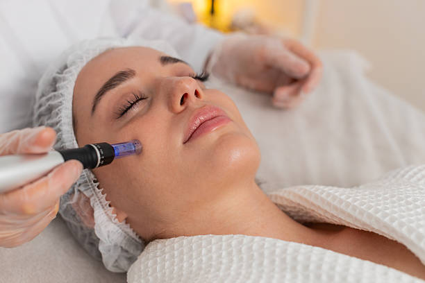 Does Microneedling for Acne Scars need many sessions