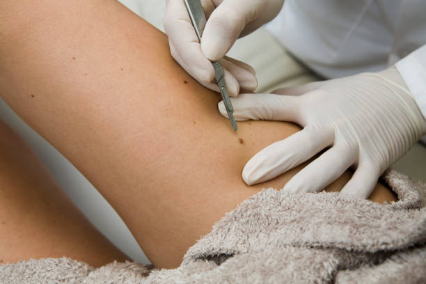 Does Skin lesion removal offer long lasting skin results?