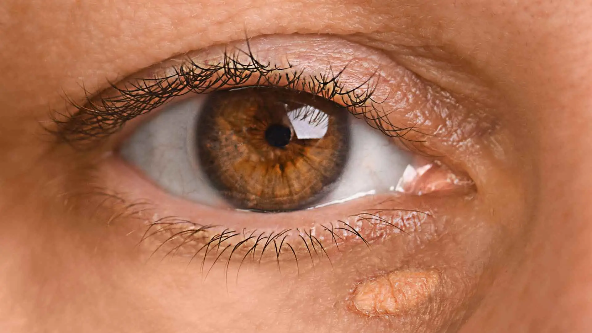 A Complete Clinic Guide to Eyelid Xanthelasma Removal Treatments