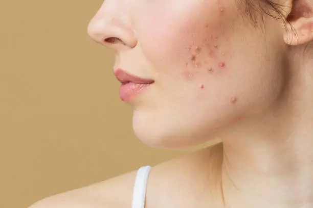 How Can Acne Treatment Support Clearer-Looking Skin?