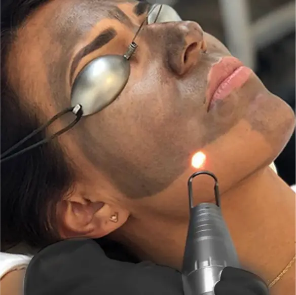 How Can Pico Laser Treatment Improve Skin Tone