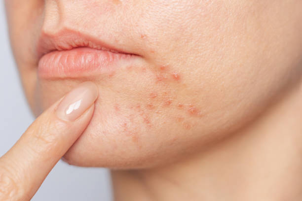 How Does Acne treatment Support Clearer Skin?