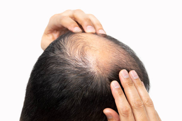How Does GFC Treatment for Hair Treat Hair Thinning?