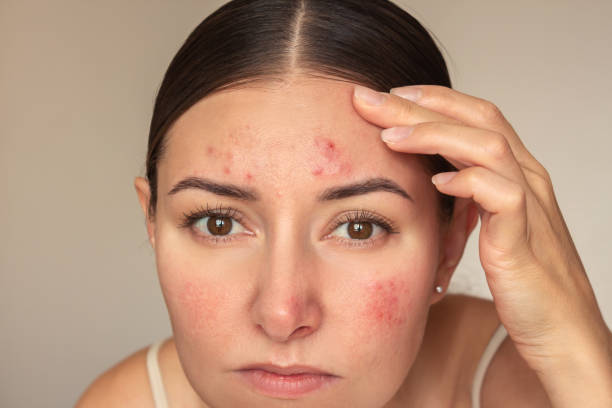 How Does Laser Acne Scar Treatment Renew Skin